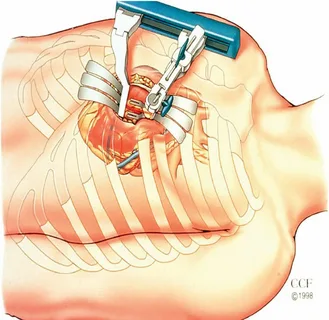Beyond Blocked Arteries: How CABG Surgery Is Transforming Modern Heart Care
